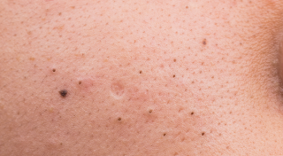 Whiteheads / blackheads