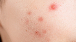 Red pimples