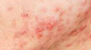 Painful acne