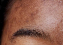 Dark spots/pigmentation
