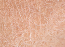 Dry barrier damaged skin