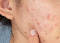 Persistent acne /breakouts
