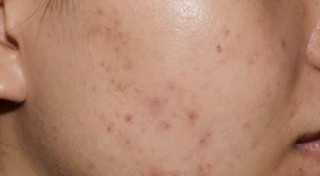 Dark spots from past pimples