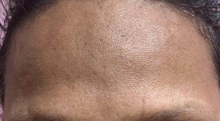 Patches on cheeks, forehead, or upper lip