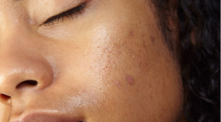 Overall dull or uneven skin tone