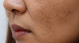 Sun-induced dark spots or tanning