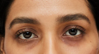 Dark circles under the eyes