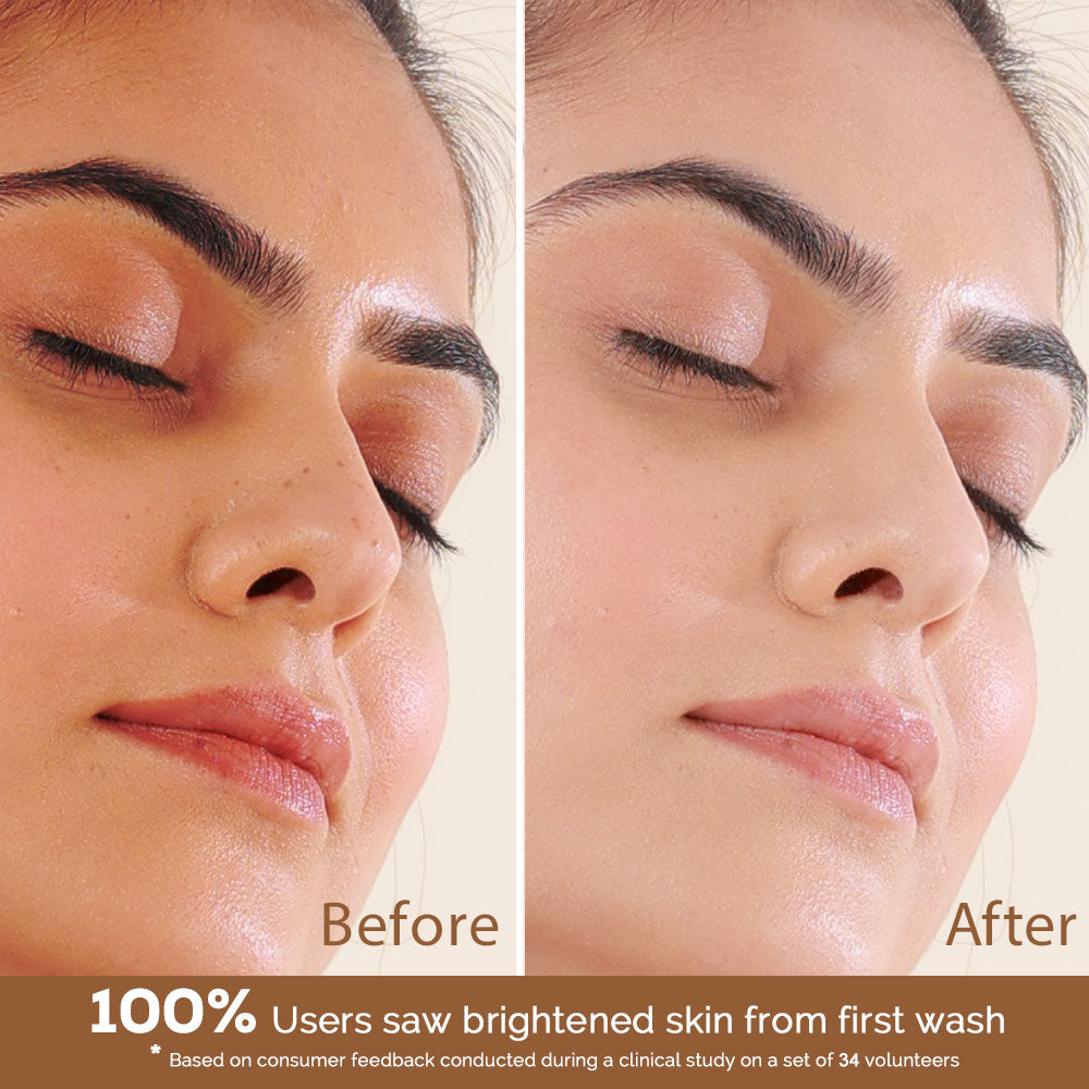 Richfeel Calendula Anti Acne Soap 75 G Pack of 4